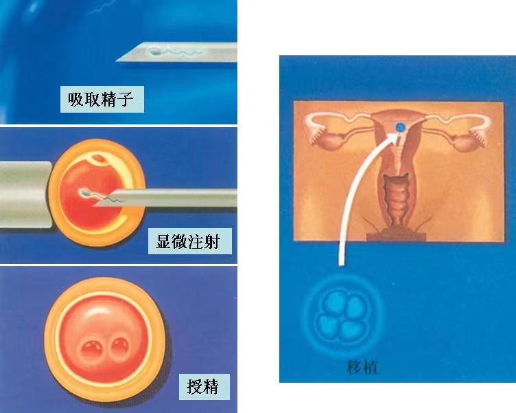 二代试管自取自怀8.8万———广州试管助孕价格